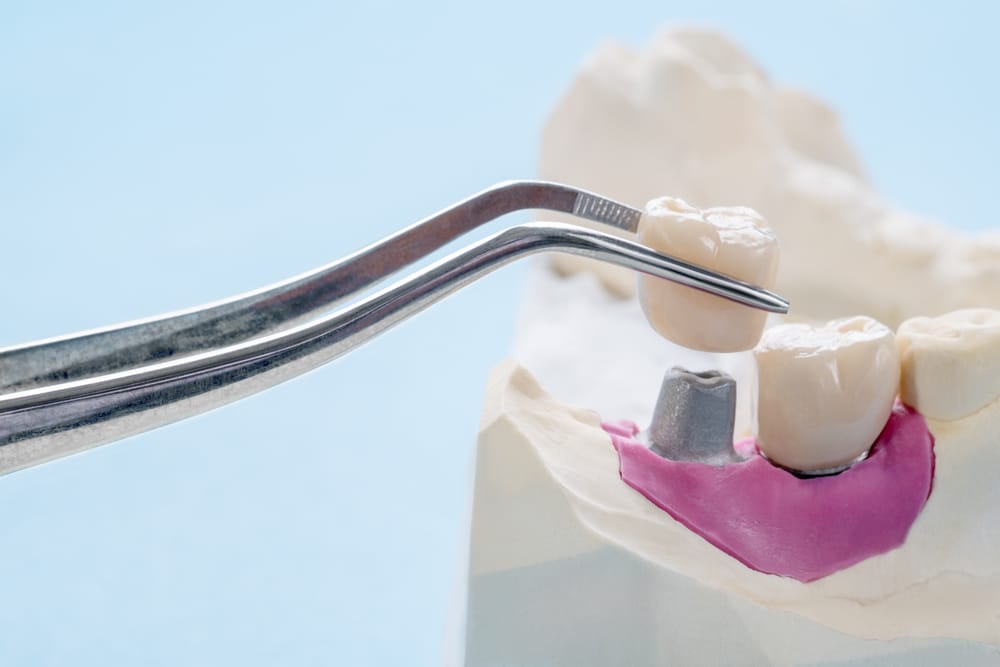 A dental model showing a crown being placed onto an implant using dental tweezers - dental bridge